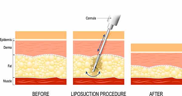 Lipedema Surgery