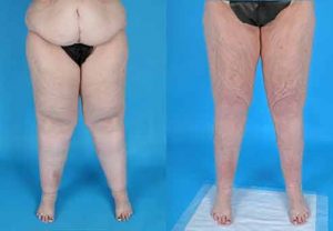 Lipedema