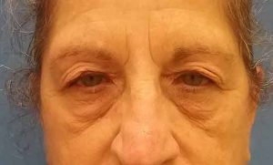 Eye-lid-preop-open