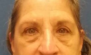 eye-lid-post-op-open eye lid surgery