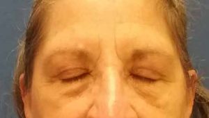 post-op-eyelid-closed eye lid surgery