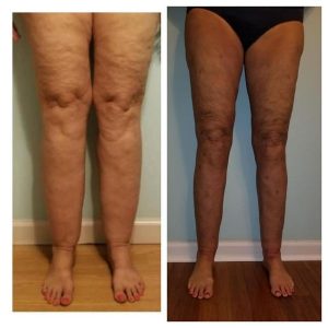 Lipedema Testimonial