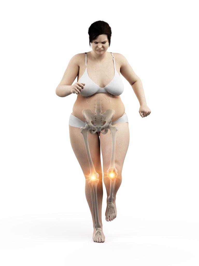 Lipedema Joint complications