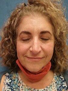 After Blepharoplasty
