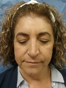Before Blepharoplasty