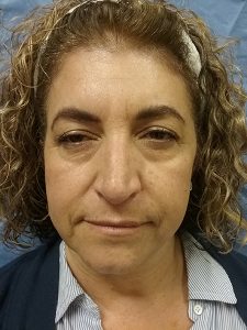 Before Blepharoplasty