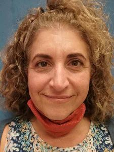 After Blepharoplasty