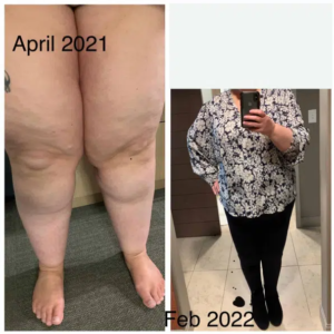 Lipedema, it's not your fault