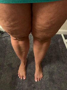 Lipedema, It's not your fault