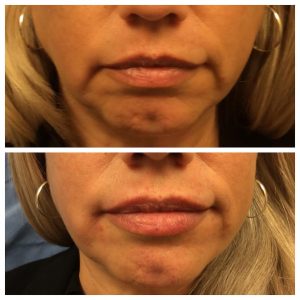 RHA Fillers before and after