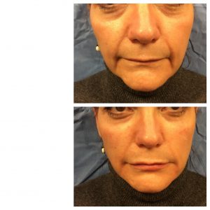 RHA for lines around mouth RHA Facial Fillers Before & After