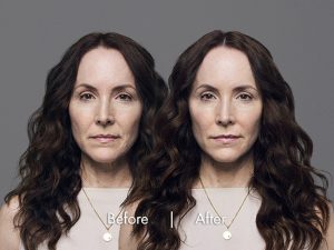 RHA Collection of Fillers