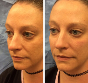 Facial Fillers
