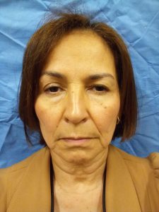 IMG_20230406_143123 Before and After Blepharoplasty