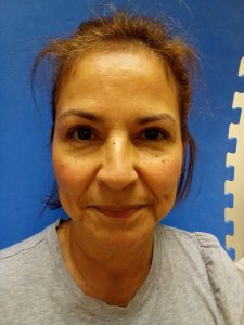 IMG_20230811_112625 After Blepharoplasty