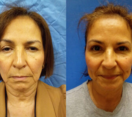 Blepharoplasty450X400 Blepharoplasty