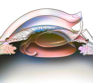 Cataract Surgeery
