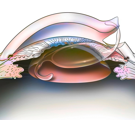 Cataract Lens Replacement Surgery