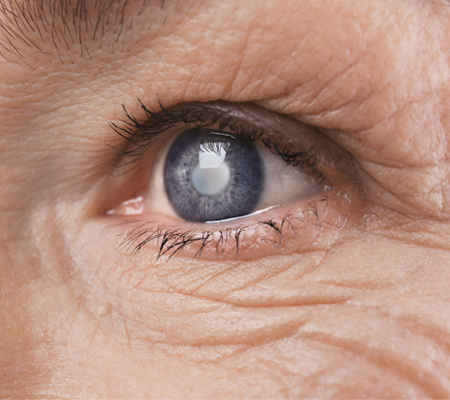 Custom Cataract Surgery