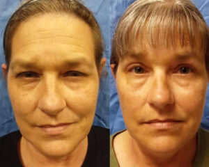 Blepharoplasty