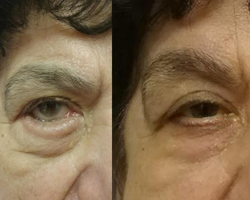 Entropion https://definitive13.com/eyelid-surgery-and-festoons-before-after-photos/