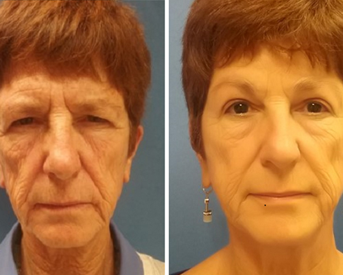 bleph bunin https://definitive13.com/eyelid-surgery-blepharoplasty/