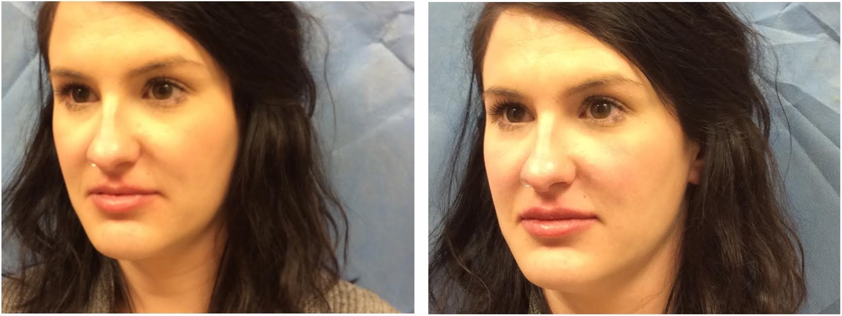 Lips-53017 Restylane Lyft Before and after Photos
