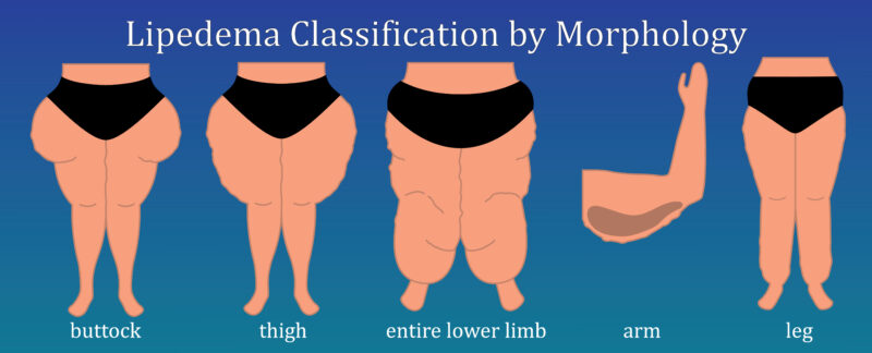 Diagnosing Lipedema