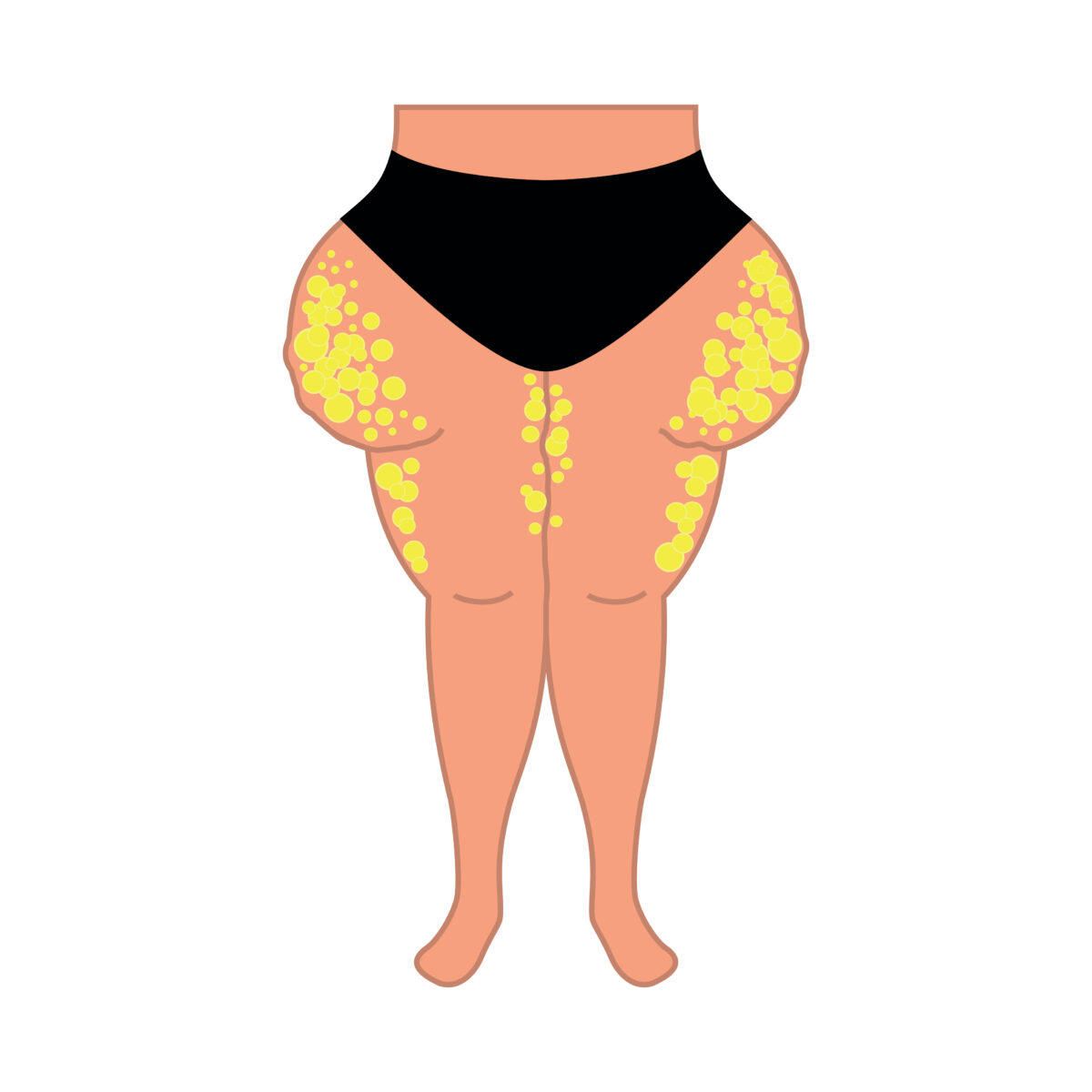 Lipedema fat