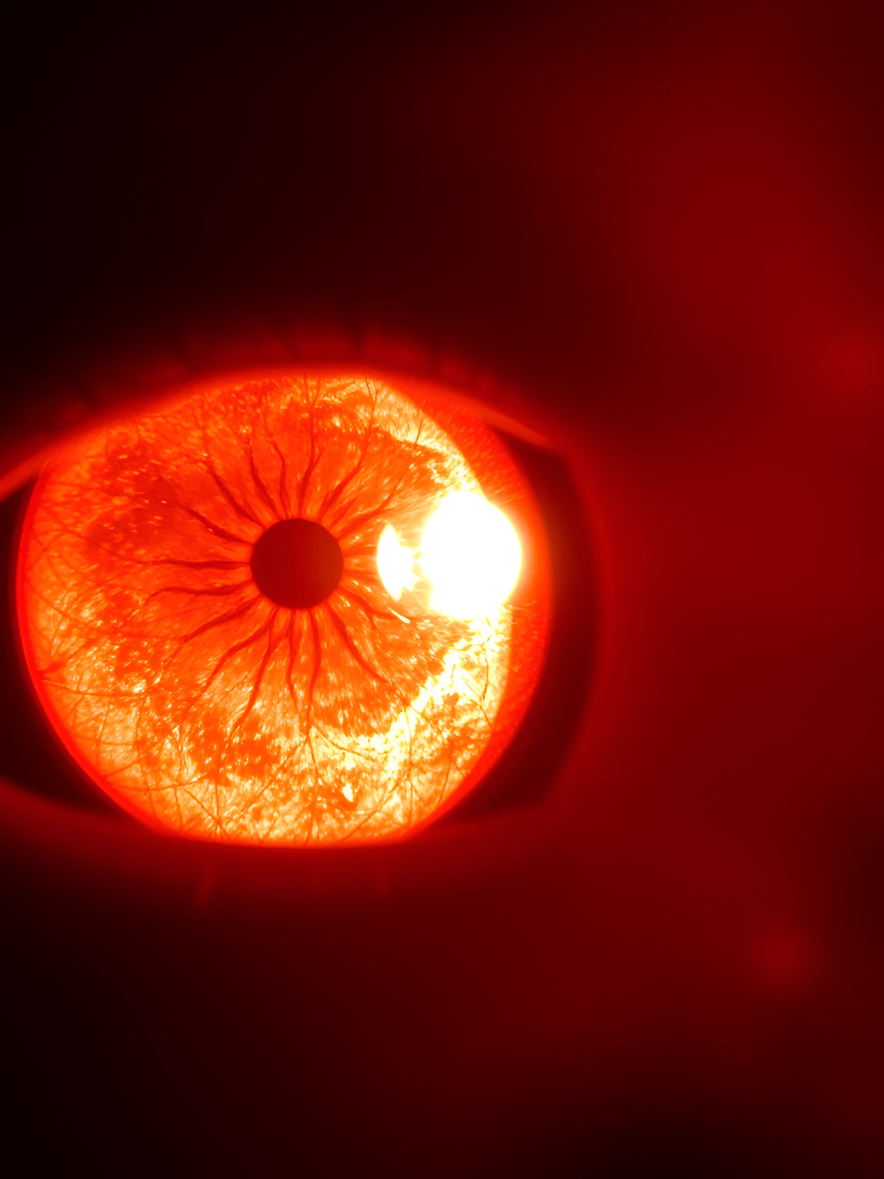 Diabetes related retinopathy medical eye exam for diabetes