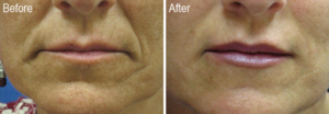 Radiesse® – Facial Wrinkle Filler